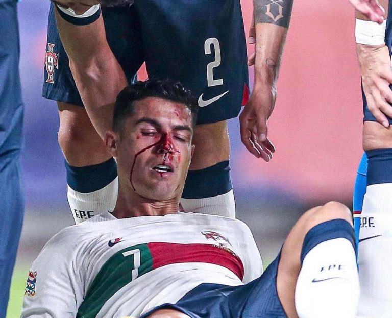 Dëmtim i frikshëm i Cristiano Ronaldos (VIDEO)